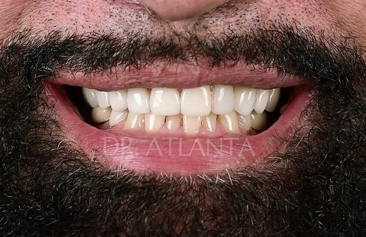 Smile makeover after a porcelain veneer smile makeover by Dr. Eric Ennuson, DDS