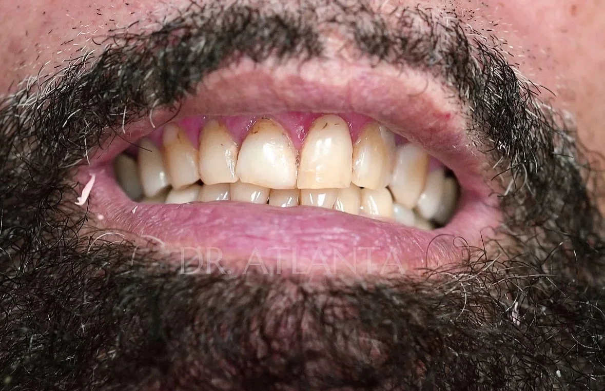 Smile makeover before a porcelain veneer smile makeover