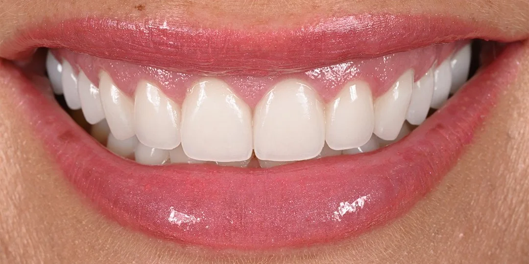 Charlotte C. after porcelain veneers by Dr. Eric Ennuson, DDS