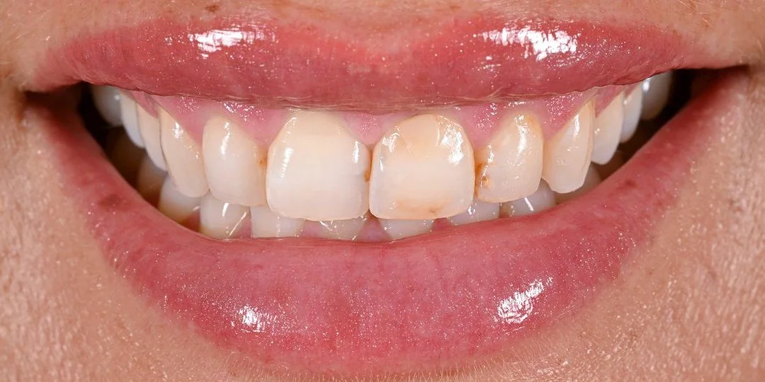 Charlotte C. before porcelain veneers