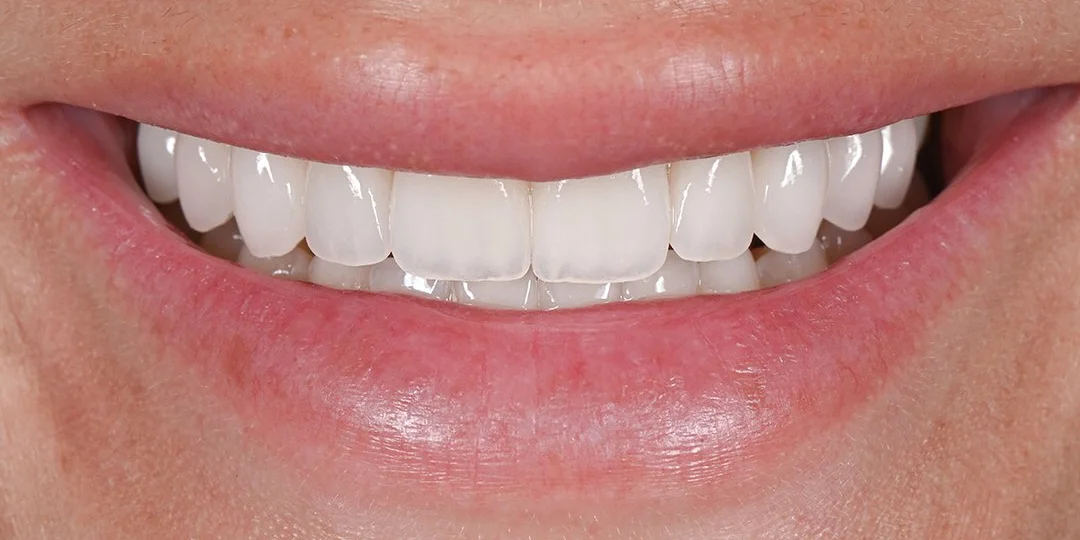 Dana B. after porcelain veneers by Dr. Eric Ennuson, DDS