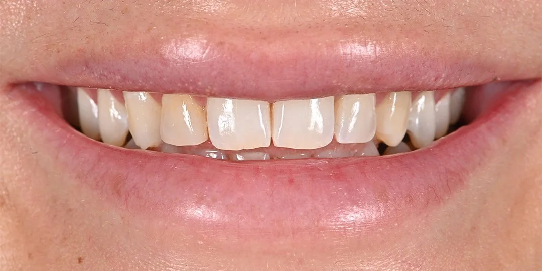 Dana B. before porcelain veneers