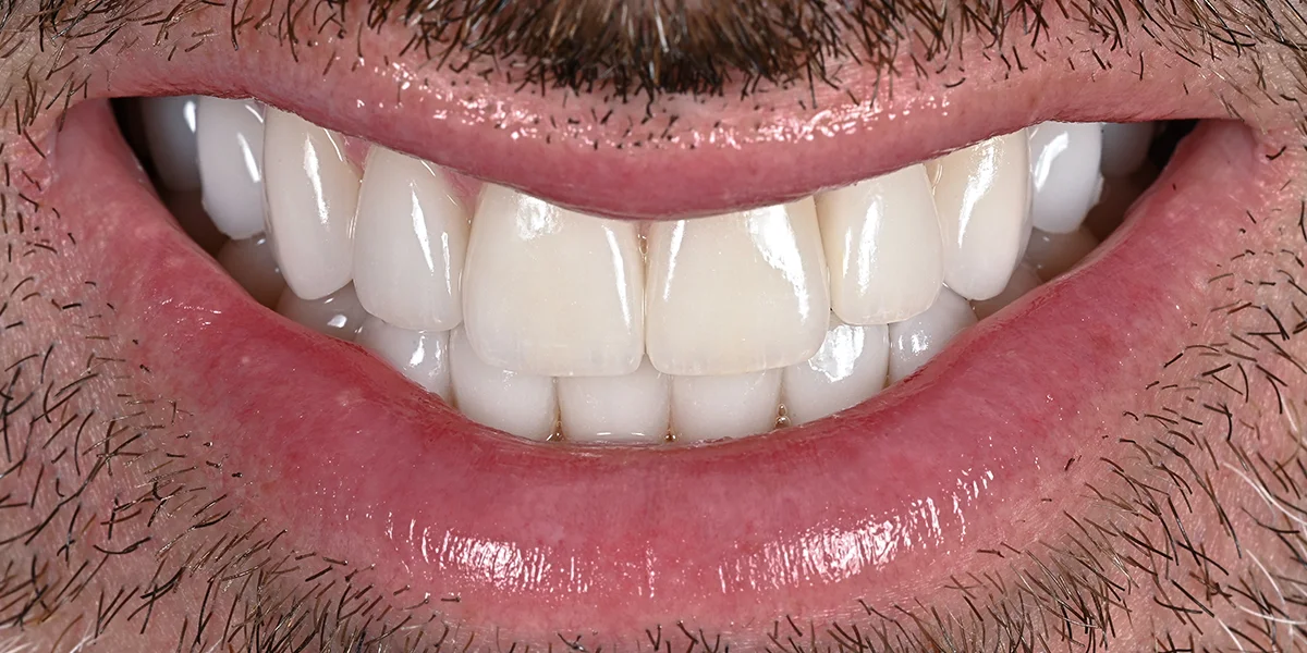 Dov G. after porcelain veneers by Dr. Eric Ennuson, DDS