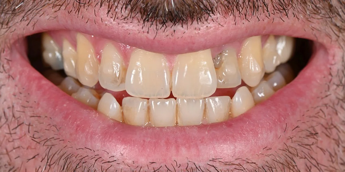 Dov G. before porcelain veneers