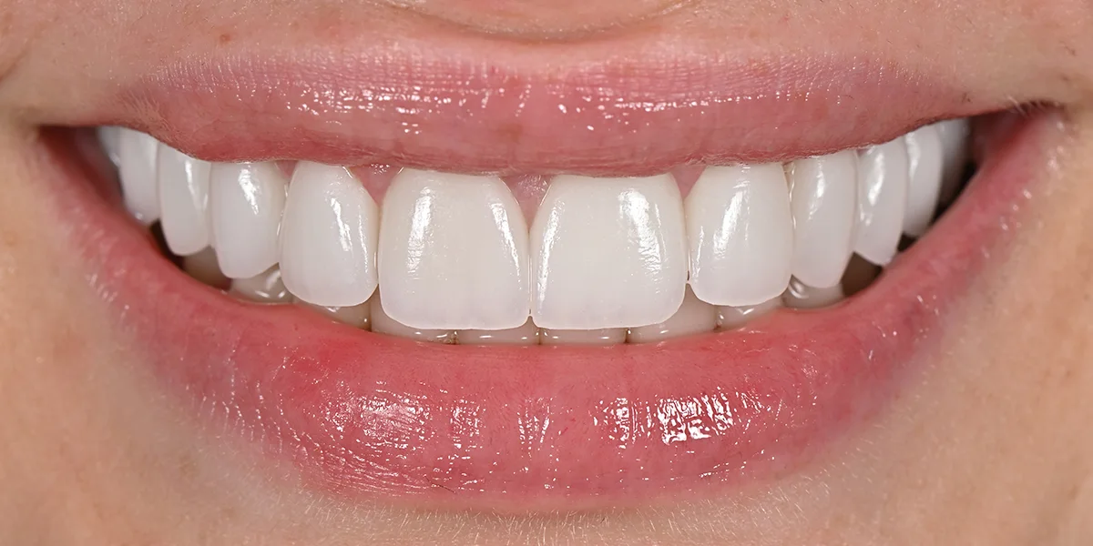Sarah R. after porcelain veneers by Dr. Eric Ennuson, DDS