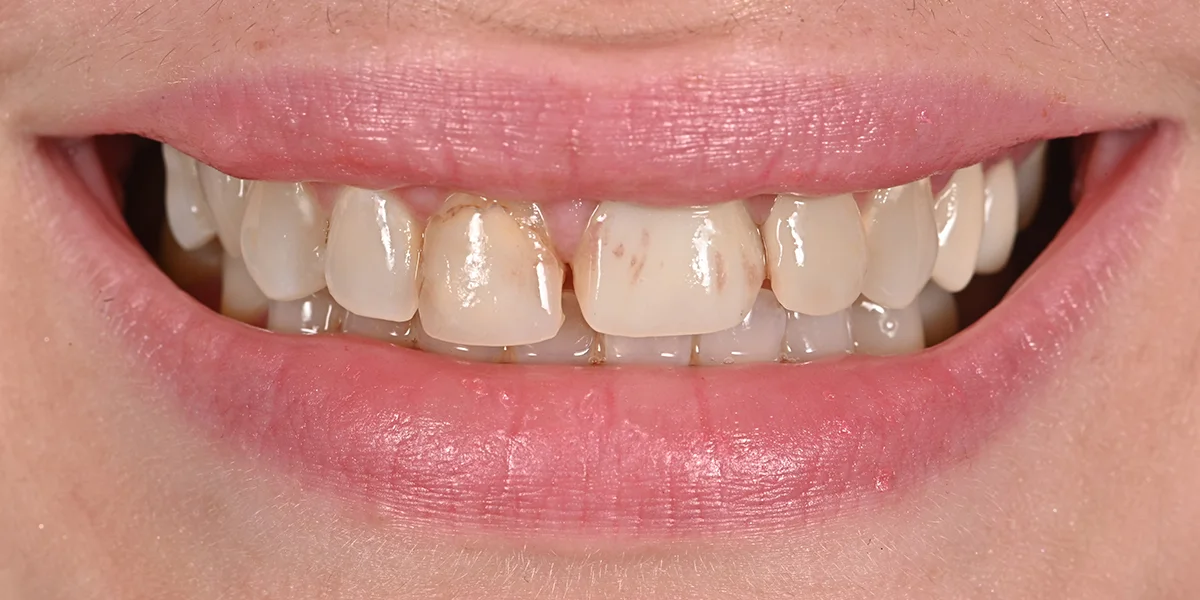 Sarah R. before porcelain veneers